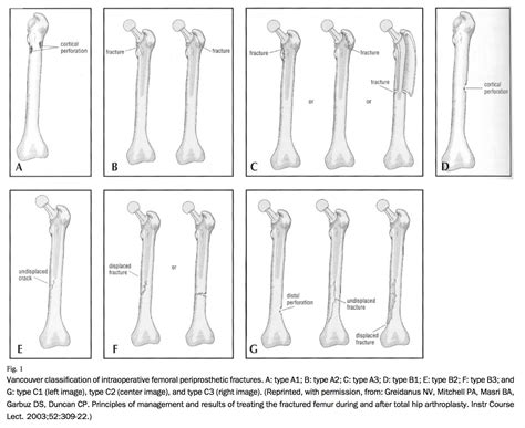 periprosthetic fracture icd 10